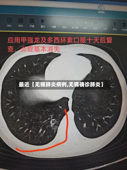 最近【无锡肺炎病例,无锡确诊肺炎】-第1张图片