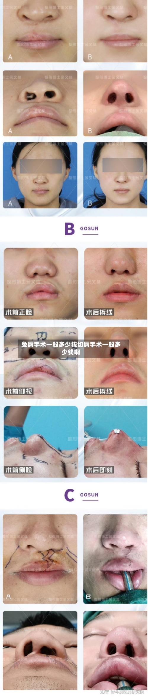兔唇手术一般多少钱切唇手术一般多少钱啊